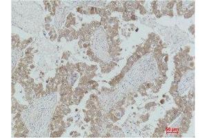 Immunohistochemistry (IHC) analysis of paraffin-embedded Human Lung Carcinoma using MEK-2 Polyclonal Antibody. (MEK2 Antikörper)