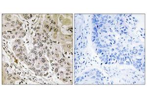 Immunohistochemistry analysis of paraffin-embedded human lung carcinoma tissue, using STK36 antibody. (STK36 Antikörper  (Internal Region))
