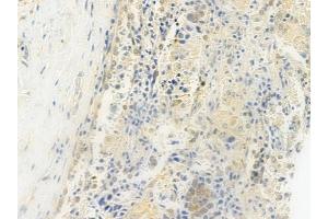 ABIN6264684 and ABIN6279171 at 1/100 staining human lung squamous cell carcinoma by IHC-P. (RECQL4 Antikörper  (Internal Region))