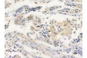 ABIN6262031 and ABIN6272484 at 1/100 staining human lung squamous cell carcinoma by IHC-P.
