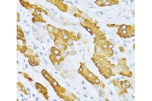 Immunohistochemistry of paraffin-embedded Human liver cancer using CYP2E1 Polyclonal Antibody at dilution of 1:100 (40x lens). (CYP2E1 Antikörper)