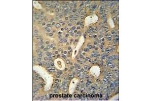 MICALL1 Antibody (C-term) (ABIN654455 and ABIN2844189) immunohistochemistry analysis in formalin fixed and paraffin embedded human prostate carcinoma followed by peroxidase conjugation of the secondary antibody and DAB staining. (MICAL-Like 1 Antikörper  (C-Term))