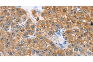 Immunohistochemistry of paraffin-embedded Human liver cancer tissue using BDH1 Polyclonal Antibody at dilution 1:60 (BDH1 Antikörper)