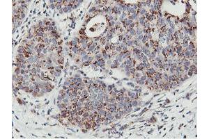 Immunohistochemical staining of paraffin-embedded Carcinoma of Human lung tissue using anti-NMT2 mouse monoclonal antibody. (NMT2 Antikörper)
