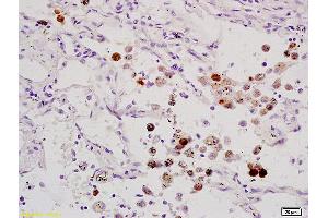 Formalin-fixed and paraffin embedded human lung carcinoma labeled with Anti-ELK1 Polyclonal Antibody, Unconjugated (ABIN685972) at 1:200 followed by conjugation to the secondary antibody and DAB staining. (ELK1 Antikörper  (AA 301-428))
