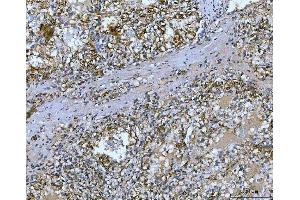 IHC analysis of Carbonic Anhydrase 9/CA9 using anti-Carbonic Anhydrase 9/CA9 antibody (ABIN7600076). (CA9 Antikörper  (AA 146-414))
