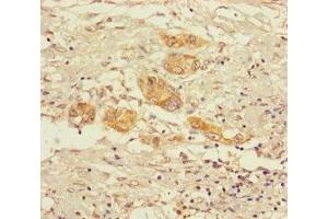 Immunohistochemistry of paraffin-embedded human pancreatic cancer using ABIN7142162 at dilution of 1:100 (alpha KGDHC Antikörper  (AA 41-423))