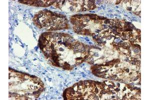 Immunohistochemical staining of paraffin-embedded Adenocarcinoma of Human ovary tissue using anti-DOK7 mouse monoclonal antibody. (DOK7 Antikörper)