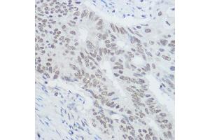 Immunohistochemistry of paraffin-embedded human colon carcinoma using XRCC1 Rabbit pAb (ABIN1683300, ABIN5663662, ABIN5663663, ABIN5663664 and ABIN6213850) at dilution of 1:300 (40x lens). (XRCC1 Antikörper  (AA 1-320))