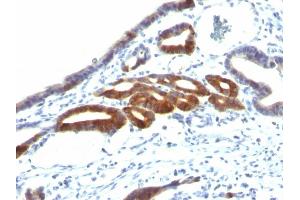 Formalin-fixed, paraffin-embedded human Gastric Carcinoma stained with MUC6 Monoclonal Antibody (SPM598). (MUC6 Antikörper)
