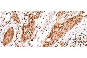 Immunohistochemistry of paraffin-embedded Human esophagus cancer tissue using AK9 Polyclonal Antibody at dilution of 1:60(x200) (Adenylate Kinase 9 Antikörper)