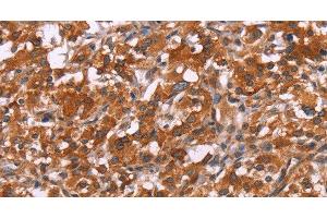 Immunohistochemistry of paraffin-embedded Human thyroid cancer tissue using HSPB6 Polyclonal Antibody at dilution 1:30 (HSPB6 Antikörper)
