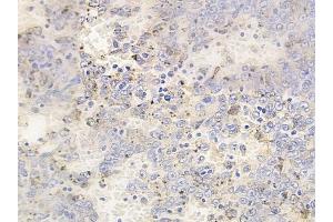 ABIN6255657 and ABIN6267507 at 1/100 staining human melanoma by IHC-P. (MAP3K8 Antikörper  (pThr290))