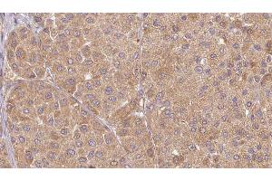 ABIN6277525 at 1/100 staining Human Melanoma tissue by IHC-P. (Urotensin 2 Antikörper  (C-Term))