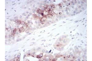 Immunohistochemical analysis of paraffin-embedded ovarian cancer tissues using RAB11FIP1 mouse mAb with DAB staining.