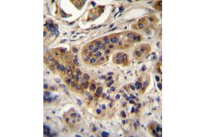 ACOX1 Antibody (N-term) A immunohistochemistry analysis in formalin fixed and paraffin embedded human bladder carcinoma followed by peroxidase conjugation of the secondary antibody and DAB staining. (ACOX1 Antikörper  (N-Term))
