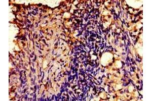 Immunohistochemistry of paraffin-embedded human ovarian cancer using ABIN7175412 at dilution of 1:100 (AVPR2 Antikörper  (AA 221-271))
