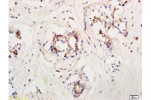 Formalin-fixed and paraffin embedded human breast carcinoma labeled with Anti LIFR/CD118 Polyclonal Antibody, Unconjugated (ABIN686827) at 1:200 followed by conjugation to the secondary antibody and DAB staining