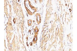 Formalin-fixed, paraffin-embedded human Leiomyosarcoma stained with Smooth Muscle Actin Mouse Monoclonal Antibody (SPM332).