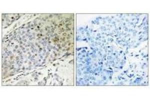 Immunohistochemistry analysis of paraffin-embedded human breast carcinoma tissue, using RMP antibody.
