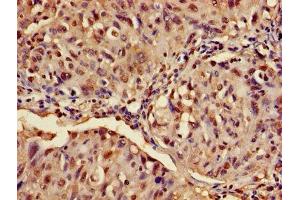 Immunohistochemistry of paraffin-embedded human lung cancer using ABIN7144793 at dilution of 1:100 (Ataxin 3 Antikörper  (AA 1-288))
