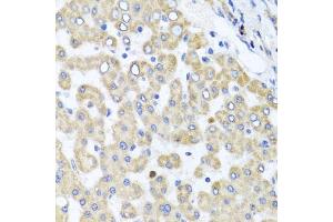 Immunohistochemistry of paraffin-embedded human liver injury using RAB24 antibody (ABIN5974578) at dilution of 1/100 (40x lens). (RAB24 Antikörper)