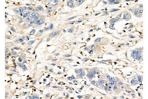 ABIN6260576 and ABIN6276962 at 1/100 staining Human gastric cancer by IHC-P. (CD151 Antikörper  (N-Term))