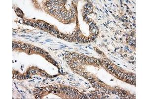 Immunohistochemical staining of paraffin-embedded Carcinoma of liver tissue using anti-BTK mouse monoclonal antibody. (BTK Antikörper)