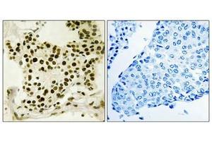 Immunohistochemistry analysis of paraffin-embedded human breast carcinoma tissue using UBF (Phospho-Ser484) antibody. (UBTF Antikörper  (pSer484))