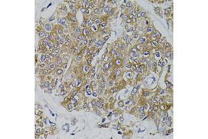 Immunohistochemistry of paraffin-embedded human prostate cancer using ARHGEF11 antibody (ABIN5995407) (40x lens). (ARHGEF11 Antikörper)