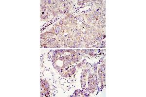 Immunohistochemical analysis of paraffin-embedded human lung cancer (upper) and colon tumour tissues (bottom) using IGF2BP3 monoclonal antibody, clone 8F11  with DAB staining. (IGF2BP3 Antikörper)