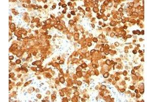 Formalin-fixed, paraffin-embedded human melanoma stained with gp100 antibody (HMB45 + PMEL/783). (Melanoma gp100 Antikörper)