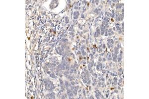 Immunohistochemistry of paraffin-embedded human colon carcinoma using NUR77 Rabbit pAb (ABIN6132395, ABIN6144826, ABIN6144829 and ABIN6222380) at dilution of 1:100 (40x lens). (NR4A1 Antikörper  (AA 1-170))