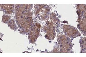 ABIN6272763 at 1/100 staining Human liver cancer tissue by IHC-P. (OR52N5 Antikörper  (C-Term))