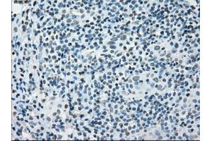 Immunohistochemical staining of paraffin-embedded Adenocarcinoma of colon tissue using anti-PRKYmouse monoclonal antibody. (PRKY Antikörper)
