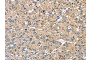 The image on the left is immunohistochemistry of paraffin-embedded Human liver cancer tissue using ABIN7192685(STK32C Antibody) at dilution 1/20, on the right is treated with synthetic peptide. (STK32C Antikörper)