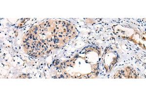 Immunohistochemistry of paraffin-embedded Human cervical cancer tissue using C16orf45 Polyclonal Antibody at dilution of 1:45(x200) (C16orf45 Antikörper)