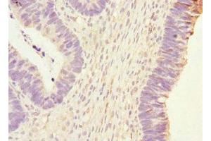 Immunohistochemistry of paraffin-embedded human ovarian cancer using ABIN7163403 at dilution of 1:100