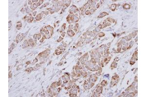 IHC-P Image Immunohistochemical analysis of paraffin-embedded human breast cancer, using NDUFA10, antibody at 1:250 dilution. (NDUFA10 Antikörper  (Center))