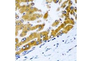 Immunohistochemical analysis of GPD2 staining in human liver cancer formalin fixed paraffin embedded tissue section. (GPD2 Antikörper)