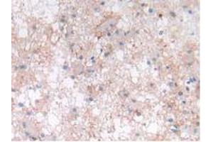 IHC-P analysis of Human Glioma Tissue, with DAB staining. (LIF Antikörper  (AA 2-201))