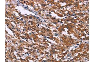 The image on the left is immunohistochemistry of paraffin-embedded Human thyroid cancer tissue using ABIN7192381(SKI Antibody) at dilution 1/40, on the right is treated with synthetic peptide. (SKI Antikörper)