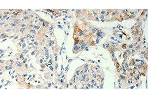 Immunohistochemistry of paraffin-embedded Human lung cancer tissue using TRPA1 Polyclonal Antibody at dilution 1:60 (TRPA1 Antikörper)