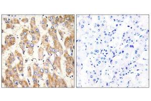 Immunohistochemistry analysis of paraffin-embedded human liver carcinoma tissue, using BAX antibody. (BAX Antikörper  (Internal Region))