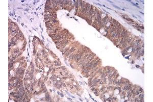 Immunohistochemical analysis of paraffin-embedded rectum cancer tissues using ASH2L mouse mAb with DAB staining. (ASH2L Antikörper  (AA 493-628))
