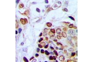 Immunohistochemical analysis of TAF15 staining in human prostate cancer formalin fixed paraffin embedded tissue section. (TAF15 Antikörper)
