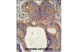 LYSMD1 Antibody (C-term) (ABIN651931 and ABIN2840459) immunohistochemistry analysis in formalin fixed and paraffin embedded human prostate carcinoma followed by peroxidase conjugation of the secondary antibody and DAB staining. (LYSMD1 Antikörper  (C-Term))