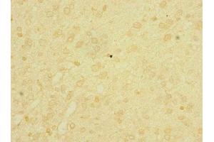 Immunohistochemistry of paraffin-embedded human glioma using ABIN7158206 at dilution of 1:100 (Lrig1 Antikörper  (AA 35-220))