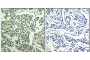 Immunohistochemical analysis of paraffin-embedded human breast carcinoma tissue using c-kit(Phospho-Tyr936) Antibody(left) or the same antibody preincubated with blocking peptide(right). (KIT Antikörper  (pTyr936))