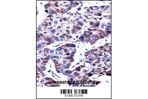 DUSP9 Antibody immunohistochemistry analysis in formalin fixed and paraffin embedded human hepatocarcinoma followed by peroxidase conjugation of the secondary antibody and DAB staining. (DUSP9 Antikörper  (C-Term))